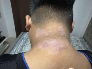 Niacinamide Soap for Eczema Relief in Mabalacat