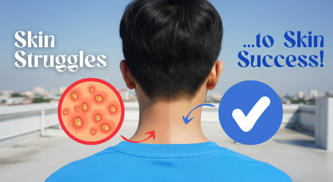 Skin Rigor From Skin Struggle to Skin Success: A Real Story from La Union - Myriad ...