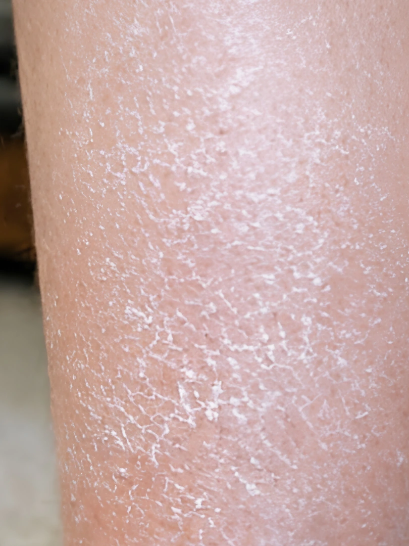 Ashy skin